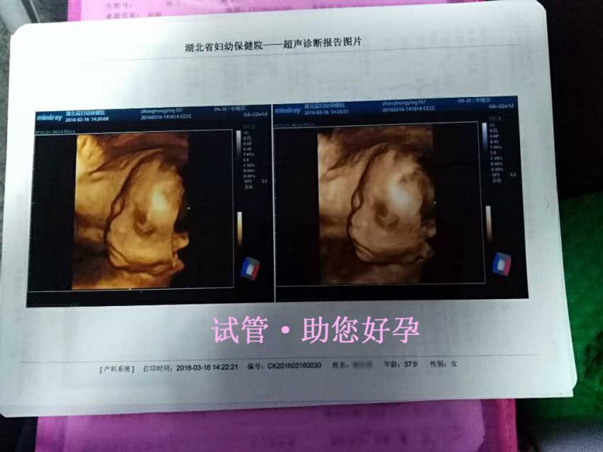 试管婴儿