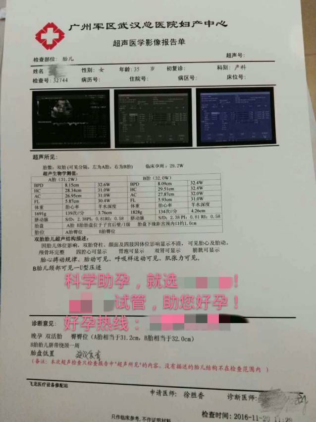 试管婴儿